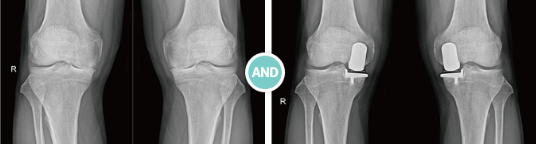 무릎 인공관절 반치환술(UKR) 사진