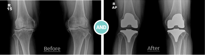 무릎 인공관절 전치환술(TKR) 사진