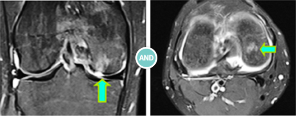 관절경 수술 사진
