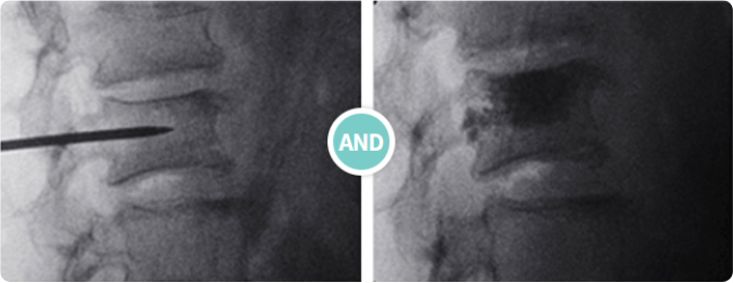 경피적 척추체 성형술 사진