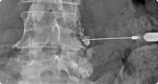 경막외 신경성형술(PEN) 사진