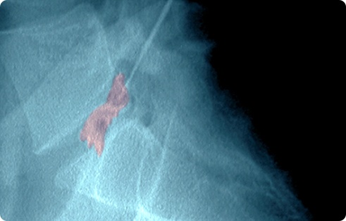 풍선성형술 사진