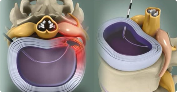 고주파수핵감압술 사진