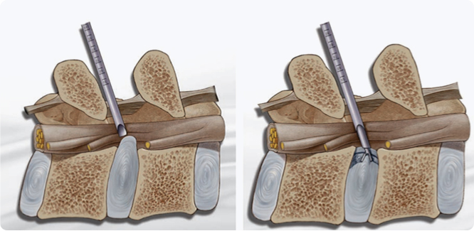 척추내시경 사진