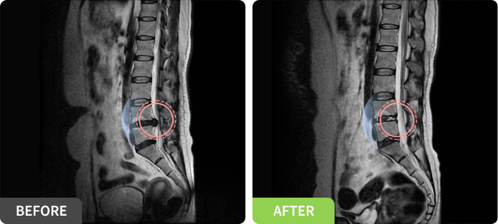 디스크절제술 사진