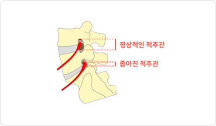시술 전 추간공 협착 이미지