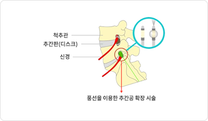선 이용한 추간공 확장 시술