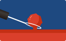 용종절제술2 사진