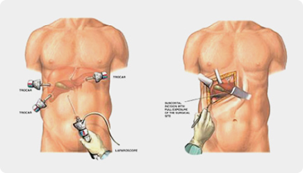 담낭 절제술 사진