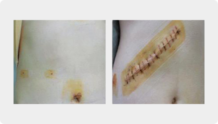 복강경 수술과 개복 수술의 비교 예시 사진