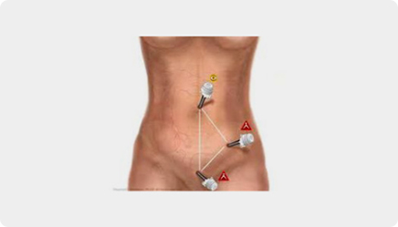 복강경 충수 절제술 사진