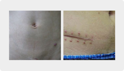 복강경 수술과 개복 수술의 비교 예시 사진