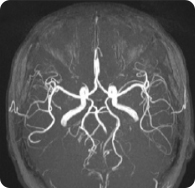뇌 MRA 사진