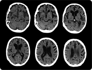 뇌혈관 CT 촬영 사진