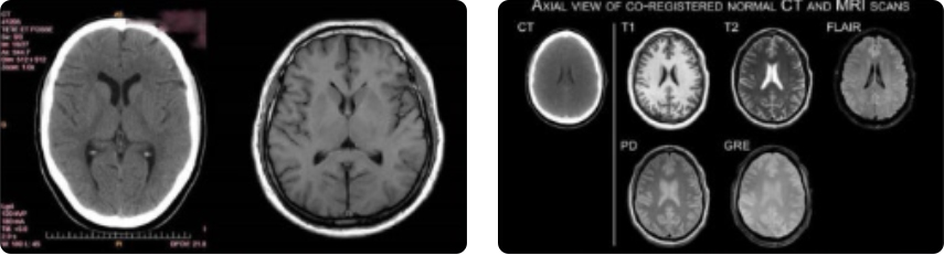 CT와 MRI 사진