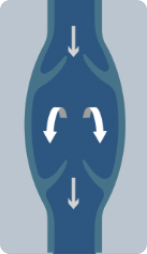 하지정맥류 이미지