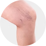 모세혈관확장증