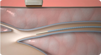 베나실 시술 순서 이미지 1