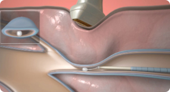 베나실 시술 순서 이미지 2