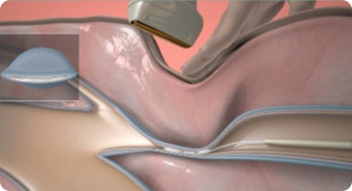 베나실 시술 순서 이미지 3