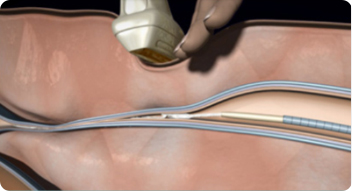 베나실 시술 순서 이미지 4