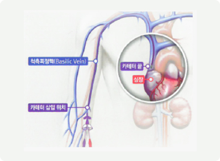 PICC 삽입 방법 이미지1
