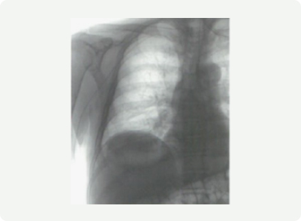 PICC 삽입 방법 이미지2